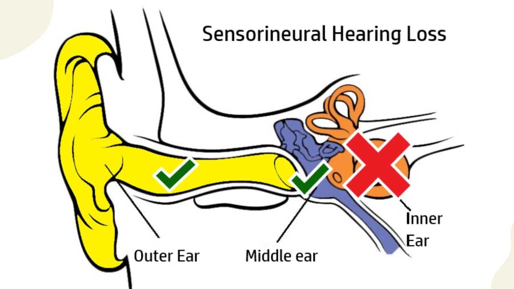 sensorineural hearing loss